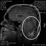 Brad's MRI showing Chiari Malformation